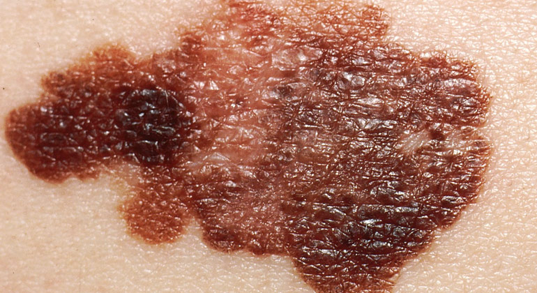 https://www.panel.illinoisderm.com/files/media/10/media__idielkgrovemelanomacondition_bf8f70e92f.jpg